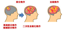 部分発作 全般発作の図