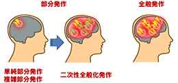 部分発作 全般発作の図