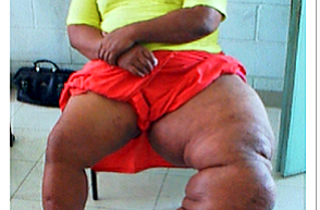 リンパ系フィラリア症制圧プログラムに関わる人々のエピソード
キリバスの人の話 – Hope –
―長崎大学一盛教授からの現地レポート
